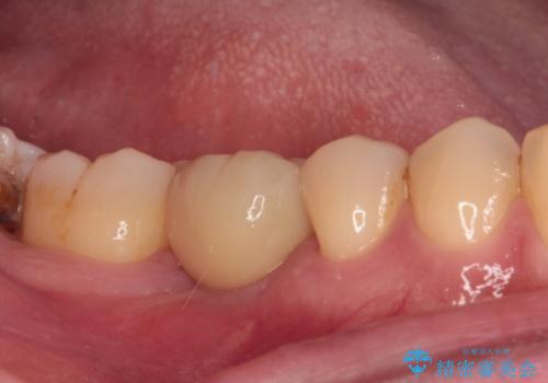 空いている時間を利用して通院 奥歯のインプラント治療の治療後