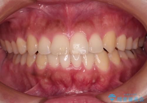 【モニター】カリエール・ディスタライザーを併用した八重歯のインビザライン矯正　の症例 治療後