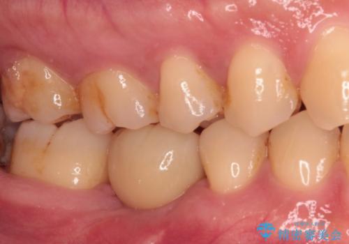 空いている時間を利用して通院 奥歯のインプラント治療の治療後