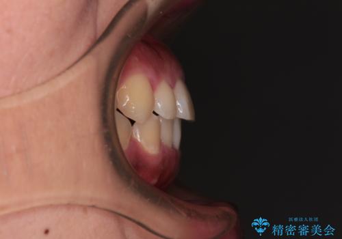 【モニター】カリエール・ディスタライザーを併用した八重歯のインビザライン矯正 の治療後