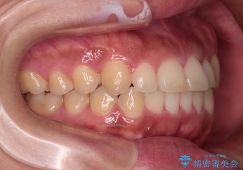 【モニター】カリエール・ディスタライザーを併用した八重歯のインビザライン矯正 の治療後