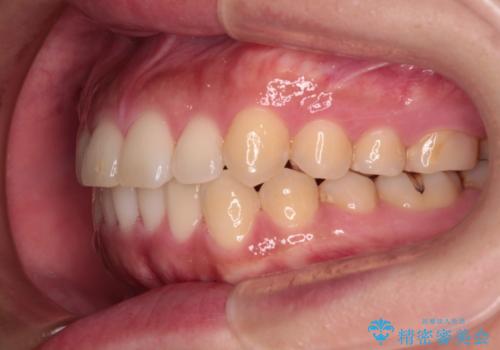 【モニター】カリエール・ディスタライザーを併用した八重歯のインビザライン矯正 の治療後