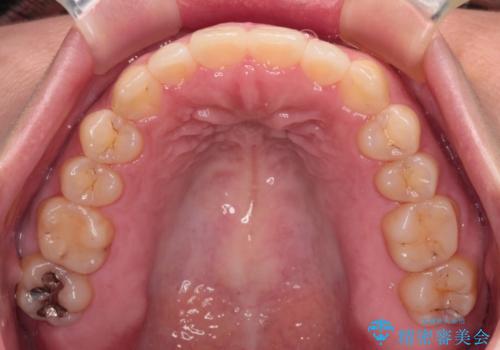 【モニター】カリエール・ディスタライザーを併用した八重歯のインビザライン矯正 の治療後