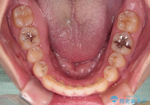 【モニター】カリエール・ディスタライザーを併用した八重歯のインビザライン矯正　の治療後