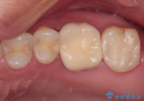 奥歯がズキズキと痛む　奥歯の虫歯治療の治療後
