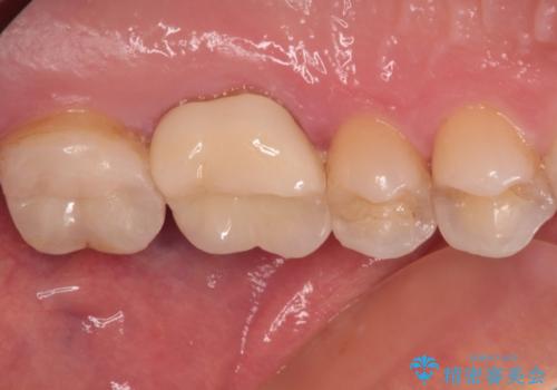 奥歯がズキズキと痛む 奥歯の虫歯治療の治療後
