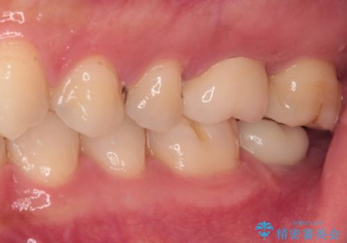 奥歯がズキズキと痛む 奥歯の虫歯治療の治療後
