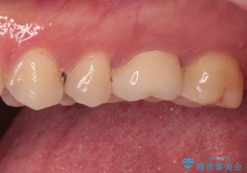 奥歯がズキズキと痛む 奥歯の虫歯治療の治療後