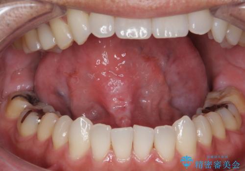滑舌が気になる　舌小帯の切除の症例 治療後