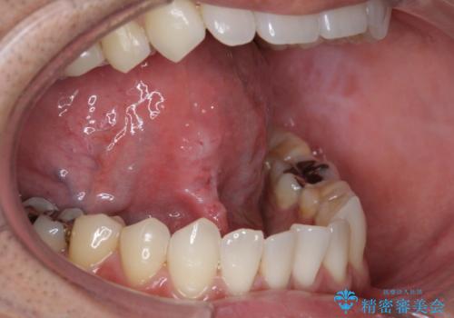 滑舌が気になる　舌小帯の切除の治療後