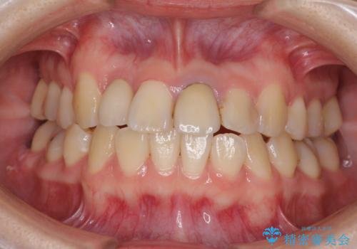 虫歯治療ついでに歯並びの後戻りを改善　インビザラインによる矯正治療の症例 治療前