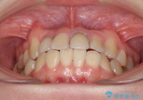 虫歯治療ついでに歯並びの後戻りを改善 インビザラインによる矯正治療の治療前