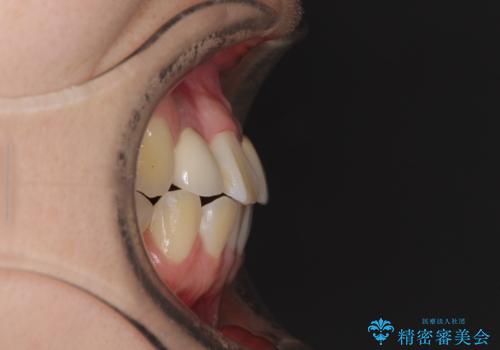 虫歯治療ついでに歯並びの後戻りを改善 インビザラインによる矯正治療の治療前