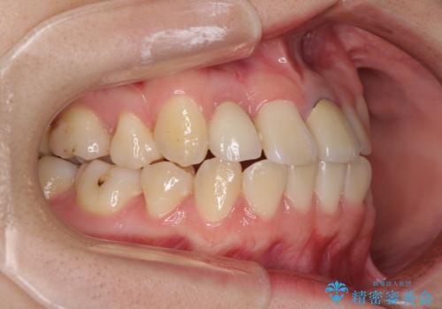 虫歯治療ついでに歯並びの後戻りを改善　インビザラインによる矯正治療の治療前