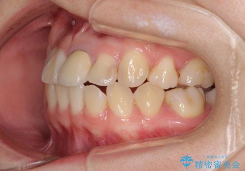虫歯治療ついでに歯並びの後戻りを改善 インビザラインによる矯正治療の治療前