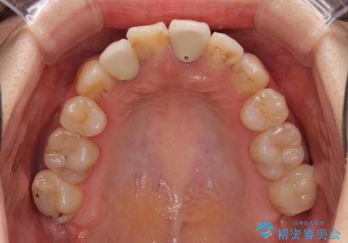 虫歯治療ついでに歯並びの後戻りを改善 インビザラインによる矯正治療の治療前