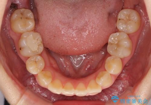 虫歯治療ついでに歯並びの後戻りを改善 インビザラインによる矯正治療の治療前