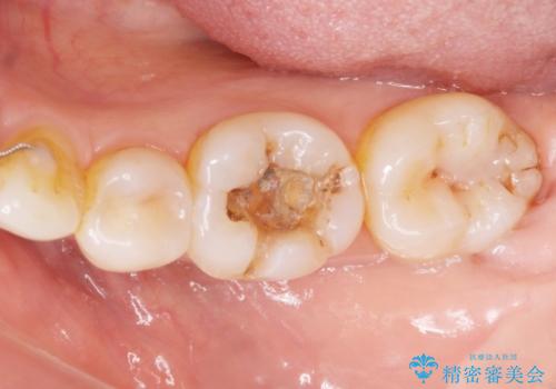e-maxインレー治療