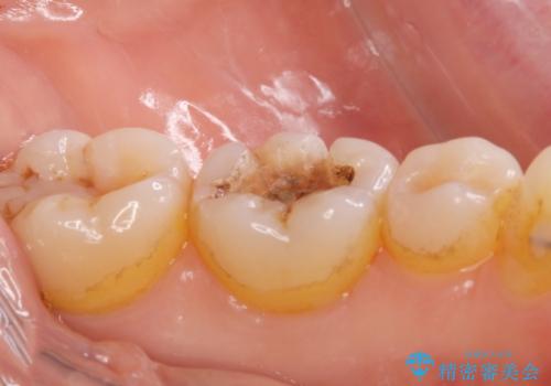 e-maxインレー治療の治療前