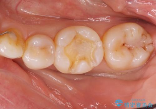 e-maxインレー治療の治療中