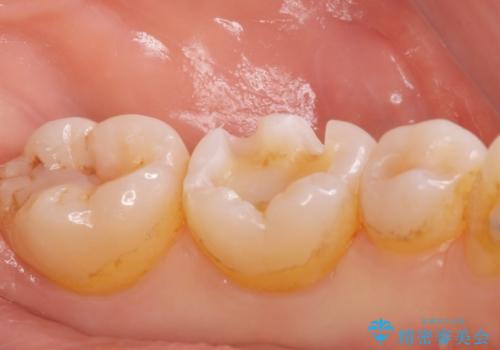 e-maxインレー治療の治療中