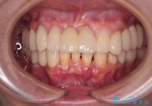 放置したインプラントとインビザライン 全顎リカバリー治療の治療後
