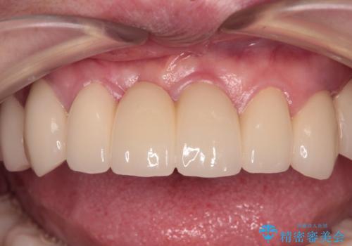 放置したインプラントとインビザライン 全顎リカバリー治療の症例 治療後
