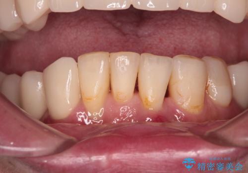 放置したインプラントとインビザライン 全顎リカバリー治療の治療後