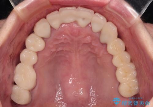 放置したインプラントとインビザライン 全顎リカバリー治療の治療後