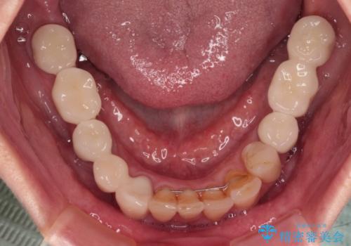 放置したインプラントとインビザライン 全顎リカバリー治療の治療後