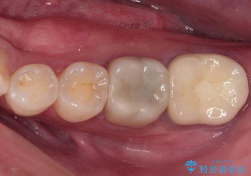 海外赴任前に治したい 割れてしまった奥歯のオールセラミッククラウンの症例 治療後