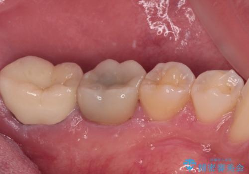 海外赴任前に治したい 割れてしまった奥歯のオールセラミッククラウンの治療後