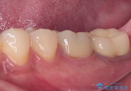 海外赴任前に治したい 割れてしまった奥歯のオールセラミッククラウンの治療後