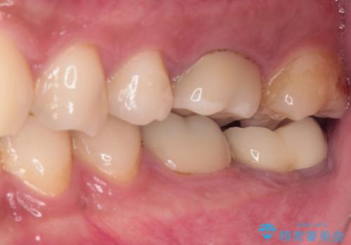 海外赴任前に治したい 割れてしまった奥歯のオールセラミッククラウンの治療後