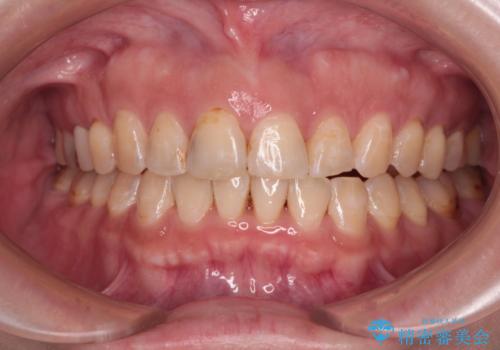 【モニター】飛び出た前歯を整えたい ワイヤー矯正治療の症例 治療後