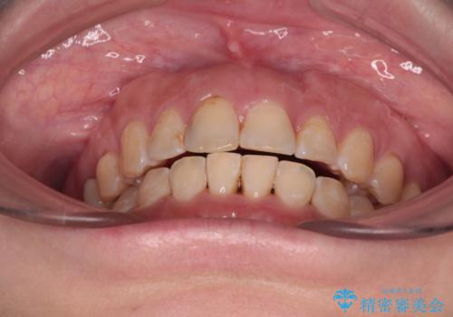 【モニター】飛び出た前歯を整えたい ワイヤー矯正治療の治療後