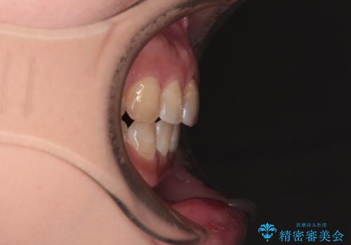 【モニター】飛び出た前歯を整えたい ワイヤー矯正治療の治療後