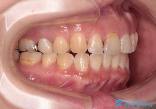 【モニター】飛び出た前歯を整えたい ワイヤー矯正治療の治療後