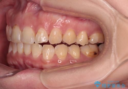 【モニター】飛び出た前歯を整えたい ワイヤー矯正治療の治療後