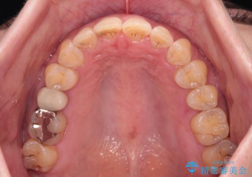 【モニター】飛び出た前歯を整えたい ワイヤー矯正治療の治療後