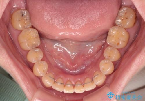 【モニター】飛び出た前歯を整えたい ワイヤー矯正治療の治療後