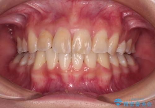 デコボコと深い咬み合わせ　ワイヤー装置での抜歯矯正の症例 治療後
