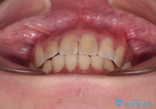 デコボコと深い咬み合わせ ワイヤー装置での抜歯矯正の治療後