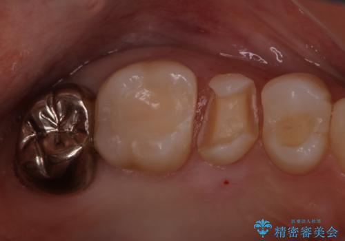 目立つ銀歯をセラミックに変えたい セラミックインレーの治療中