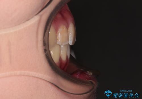 デコボコと深い咬み合わせ　ワイヤー装置での抜歯矯正の治療後