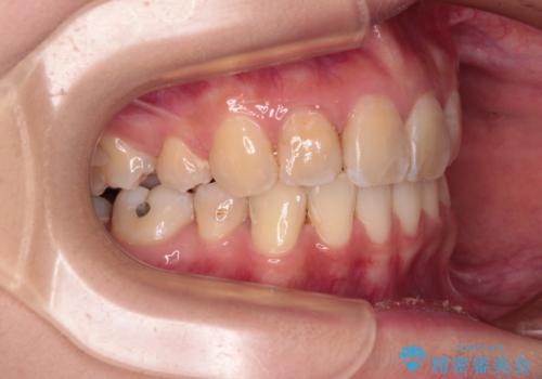 デコボコと深い咬み合わせ ワイヤー装置での抜歯矯正の治療後