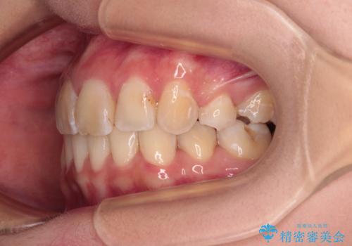 デコボコと深い咬み合わせ ワイヤー装置での抜歯矯正の治療後