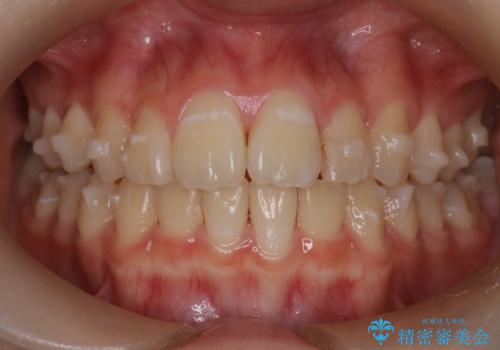 マウスピース矯正で前歯のガタツキを改善! 短期間で治療完了の治療中
