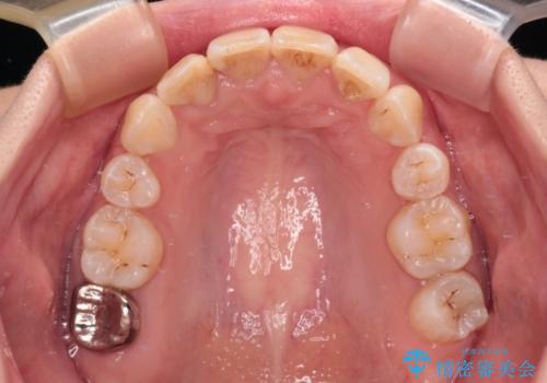 デコボコと深い咬み合わせ ワイヤー装置での抜歯矯正の治療後