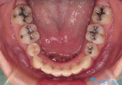 デコボコと深い咬み合わせ ワイヤー装置での抜歯矯正の治療後